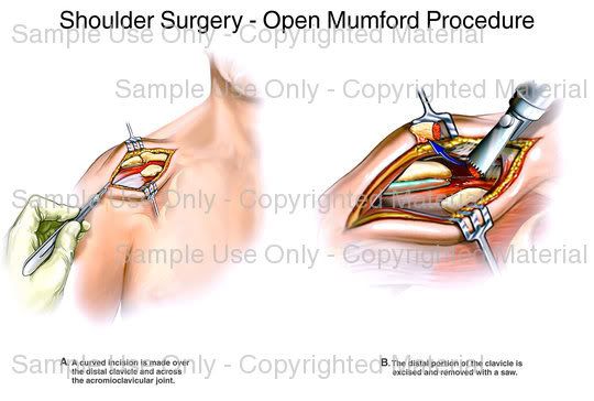 Mumford Procedure