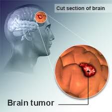Recognize Symptoms of Brain Cancer