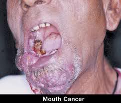 Oral Cavity Cancer