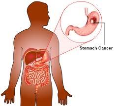 Gastric Cancer