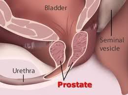 Prostate Cancer,